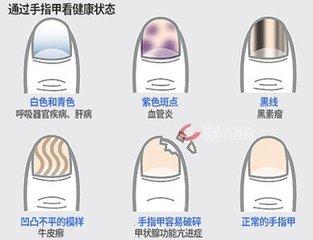 指甲显示的疾病,指甲上的各种疾病图片