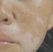 什么是损容性皮肤,损容性皮肤病名词解释