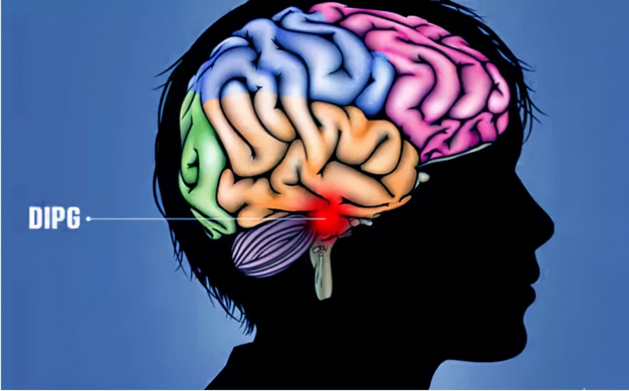 一级脑干胶质瘤,脑干胶质瘤指南