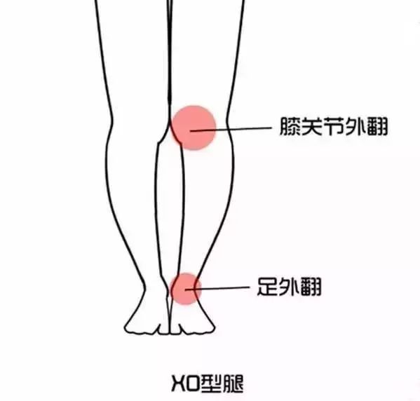 得了梨状肌怎么锻炼,得了梨状肌综合征需要注意什么