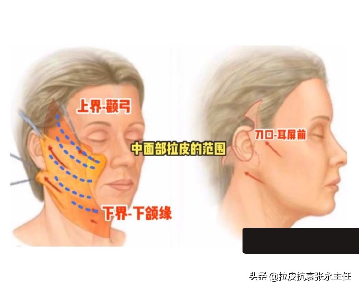 面部拉皮除皱整形多少钱一次,面部除皱拉皮手术价格是多少