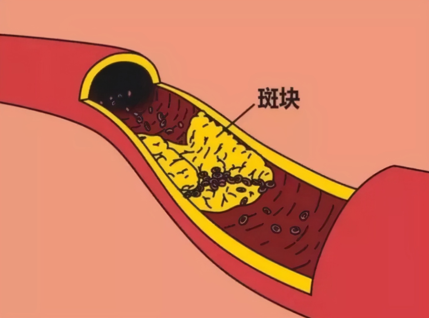 动脉斑块会掉下来吗？坦白说：不会！但导致斑块的危险因素要警惕
