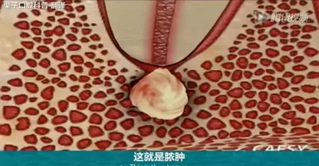 牙龈反复鼓包流脓是牙齿坏了吗,一上火牙龈就鼓包