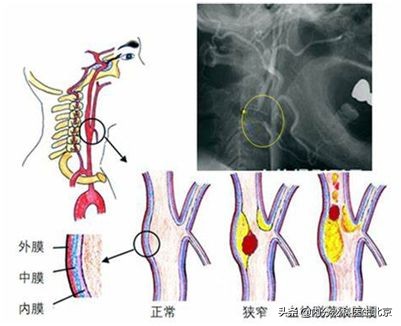 有颈动脉斑块少吃三种食物,颈动脉斑块可以按摩颈椎吗