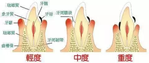 不缺牙牙槽骨吸收怎么补救,牙齿松动牙槽骨吸收最佳补救方法