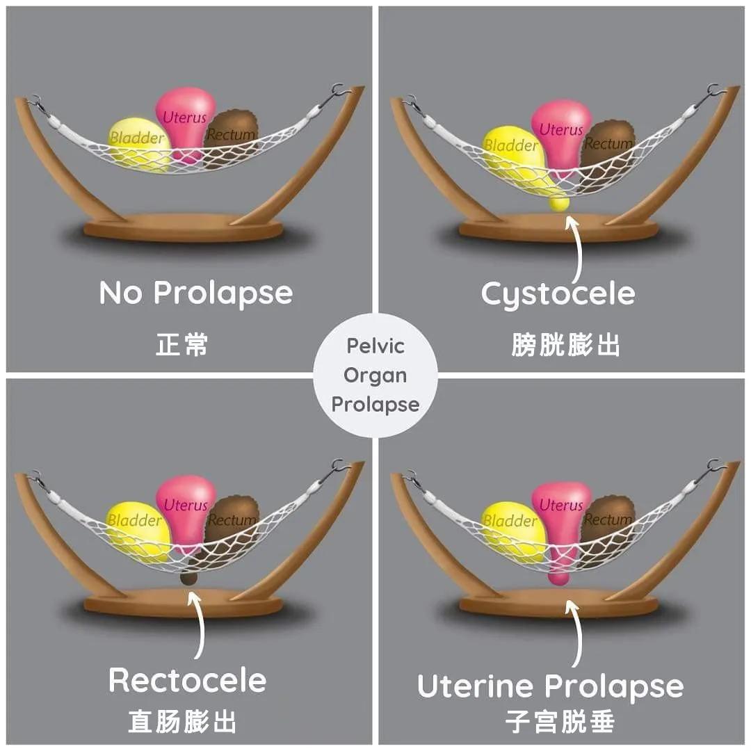孕产康复|图解盆底肌肌力测试报告
