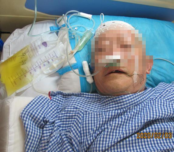 颅脑外伤术后脑积水,脑外伤脑积水颅骨缺失