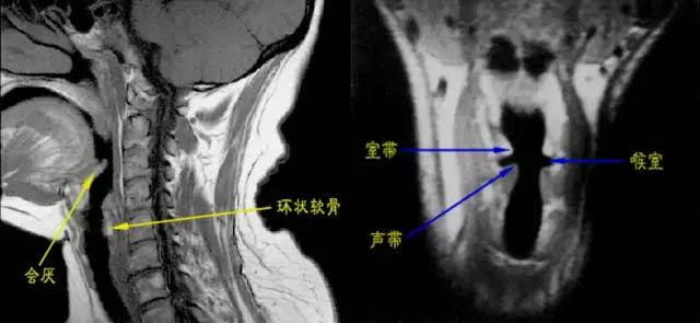 喉部病变做核磁还是ct,耳鼻喉科常见病影像诊断