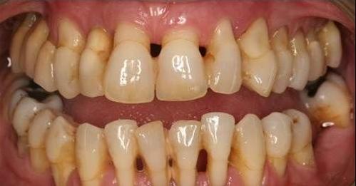 牙龈萎缩牙齿松动怎么挽救,牙龈萎缩牙齿松动严重怎么处理
