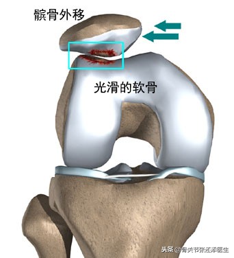 膝盖打软是髌骨错位吗,膝盖髌骨软化酸胀三个月能锻炼吗