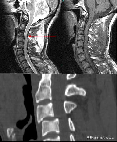 骨折的影像学检查及各自的优势,骨折的影像学愈合标准