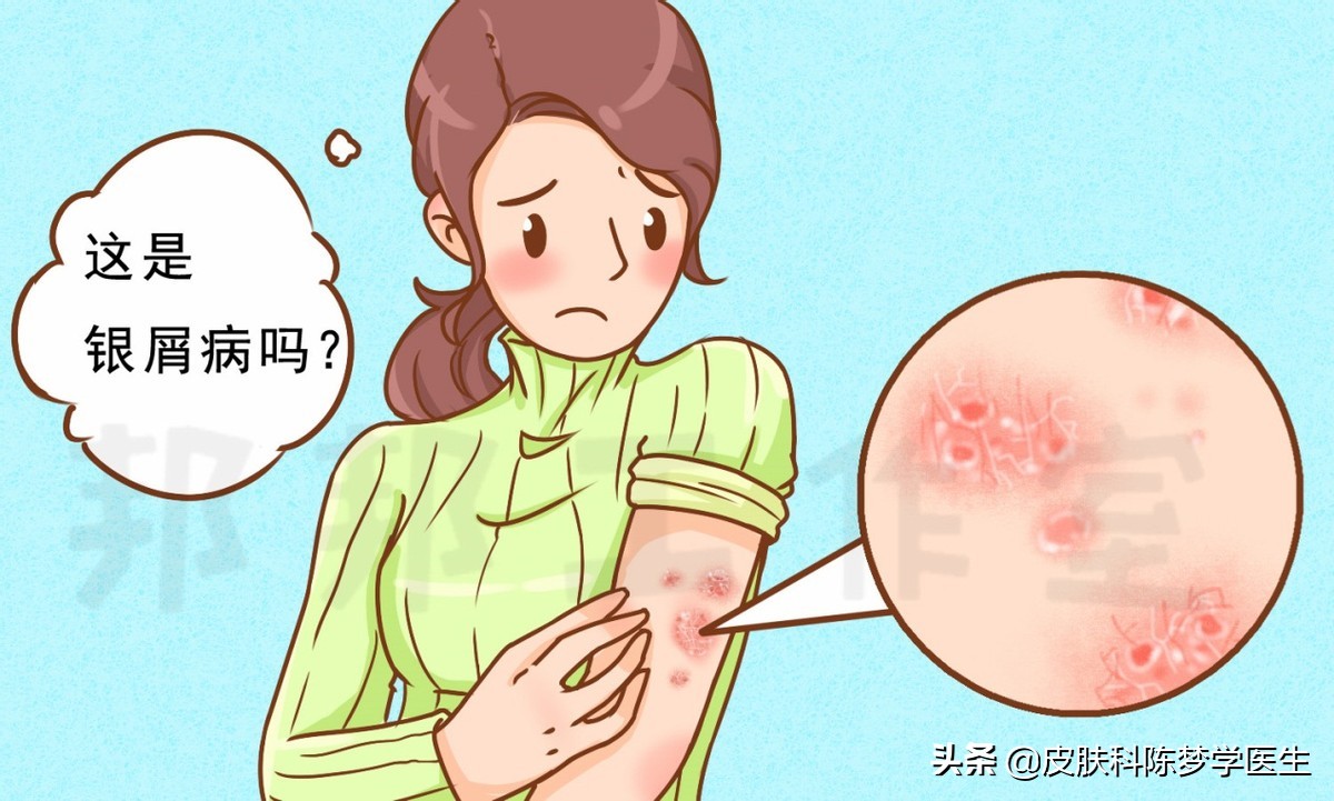 皮肤上长红斑、脱屑，是不是得了牛皮癣？