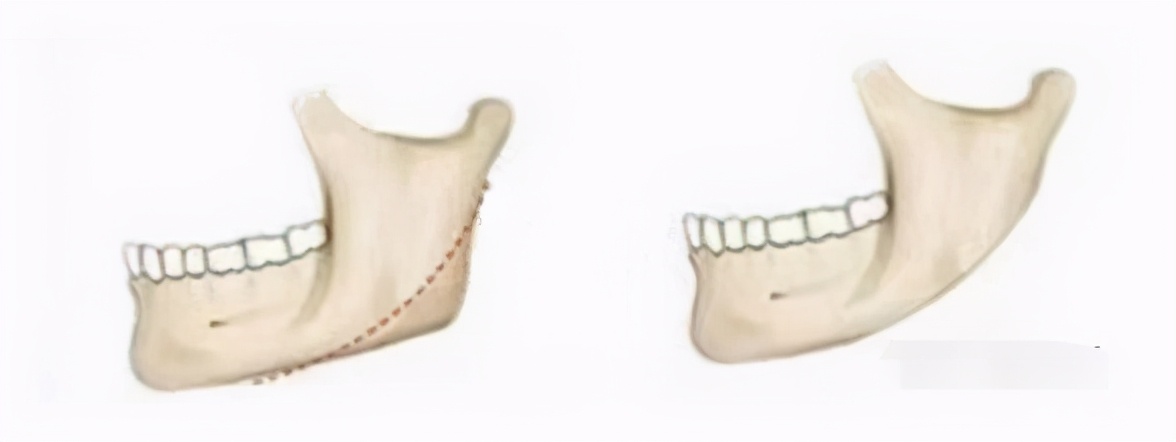 那些一刀切削骨的明星还好吗？后遗症一大堆，小方脸成最大赢家