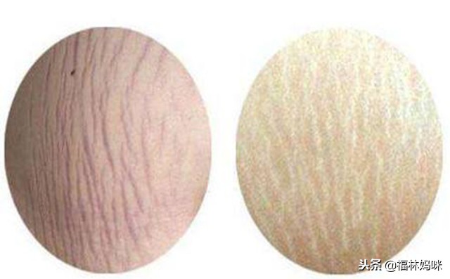 孕期多吃什么食物远离难看妊娠纹,有妊娠纹的肚子减下来会很难看吗