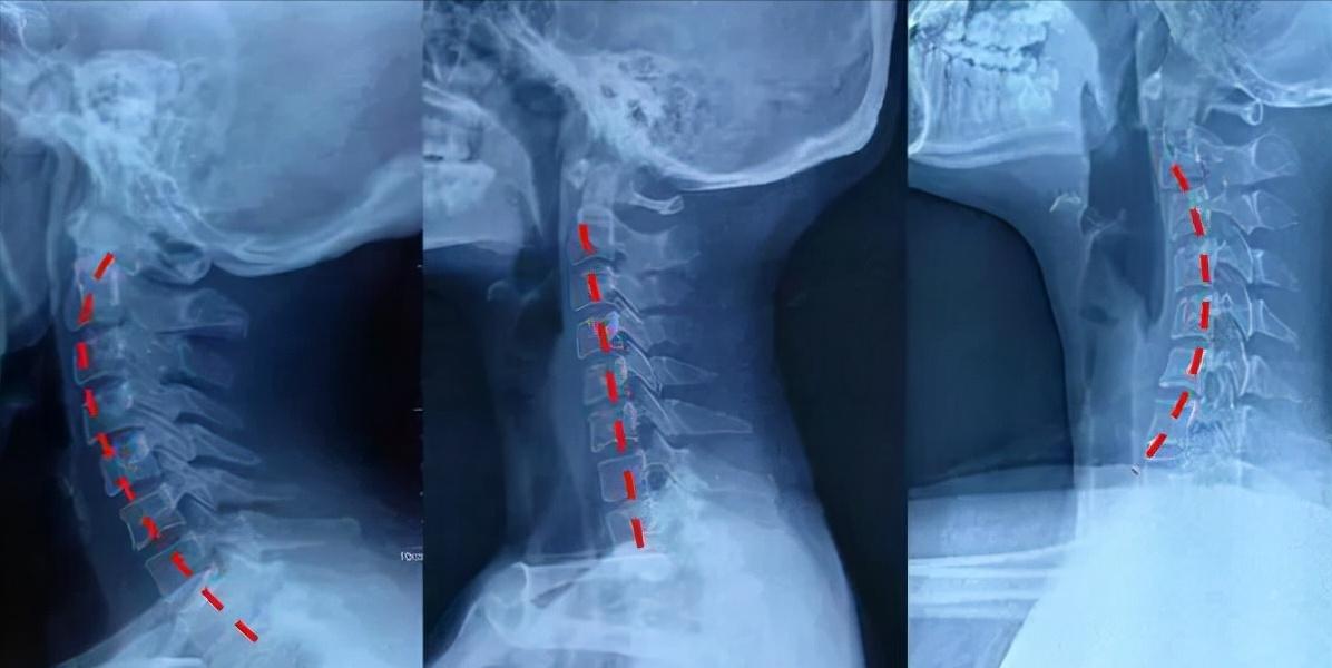 怎么选择适合自己的颈椎枕头,怎么选适合脖子的枕头