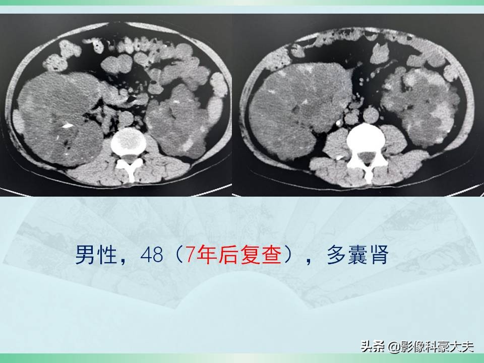 得了尿毒症又得了癌症怎么办,尿毒症为什么发病大多是年轻人呢
