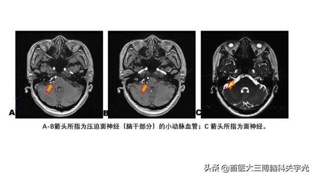 面部经常抽搐痉挛可以手术治疗,面部痉挛手术后还是抽搐