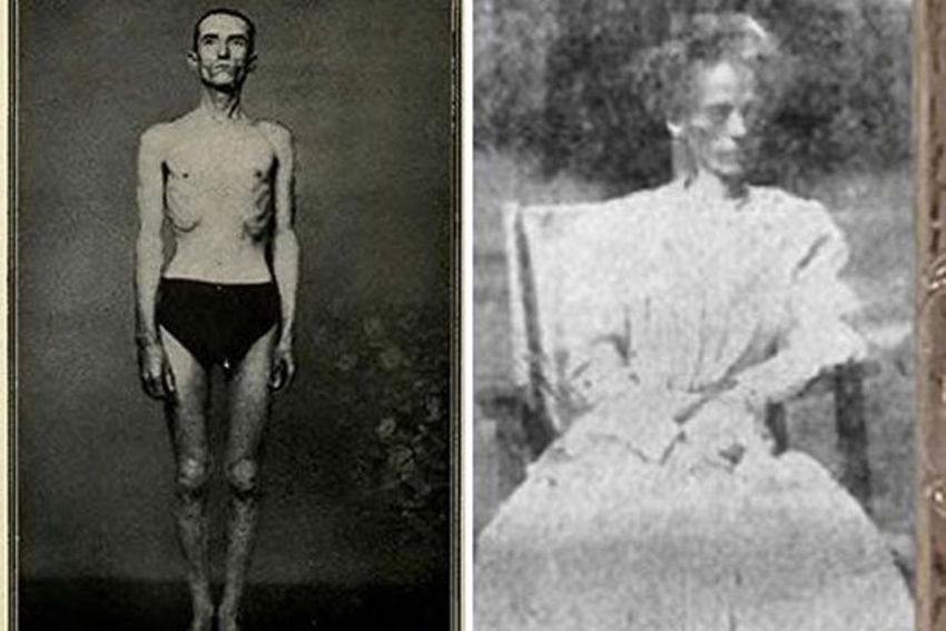 饥饿疗法专家死亡,饥饿疗法治百病是真的吗