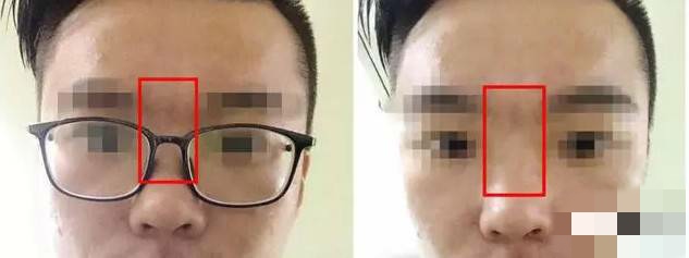 “女看眼，男看鼻”，塌鼻梁的男生如何改善？