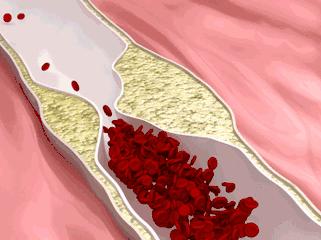 子宫肌瘤结节能治愈吗,中医消除肝结节最有效的方法