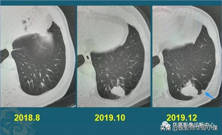 小细胞肺癌早期ct表现为什么结节,肺部ct显示有三处2cm结节是肺癌么