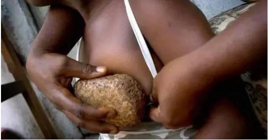 熨平少女胸部！揭秘非洲可怕习俗“烫乳”