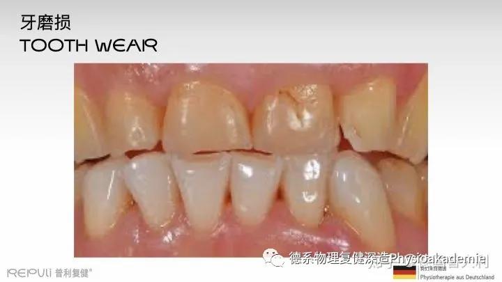 颞下颌关节紊乱综合征,颞下颌关节紊乱主要检查什么项目