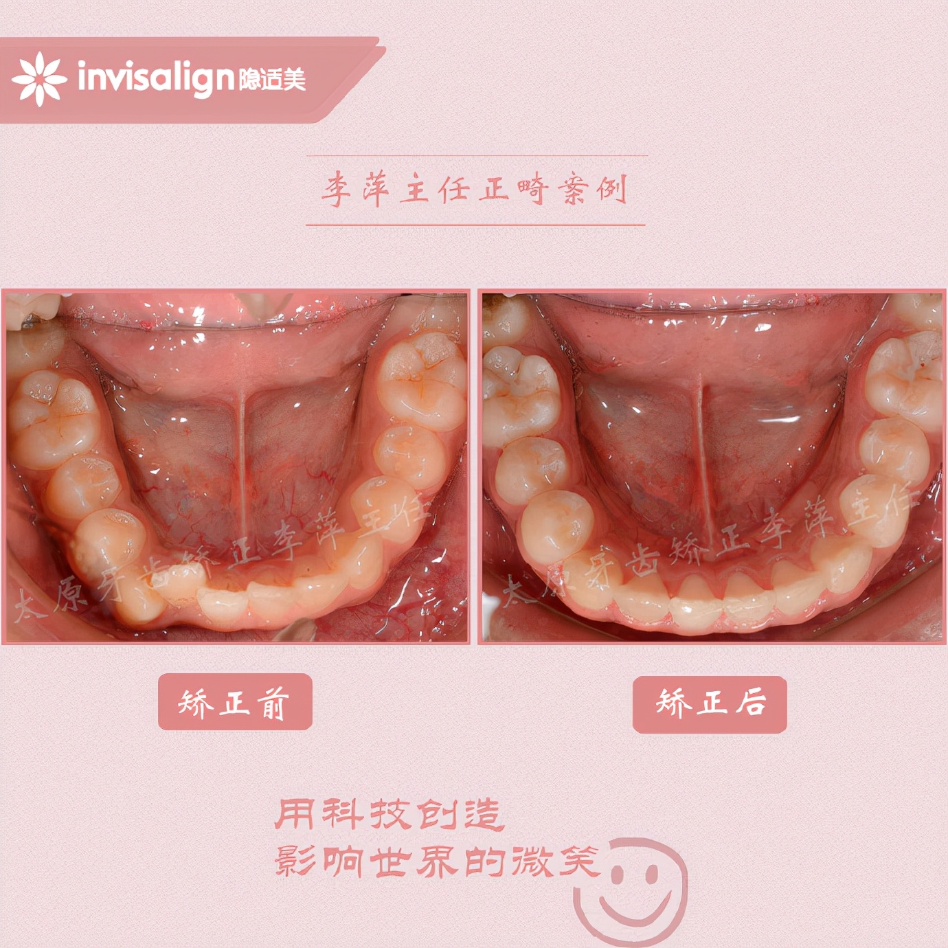 山西太原牙齿矫正医院十大排名,太原市牙齿矫正成功案