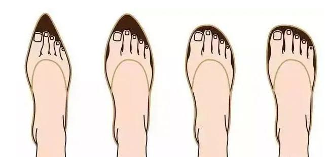 中老年女性拇外翻能矫正过来吗,女性脚拇指外翻原因