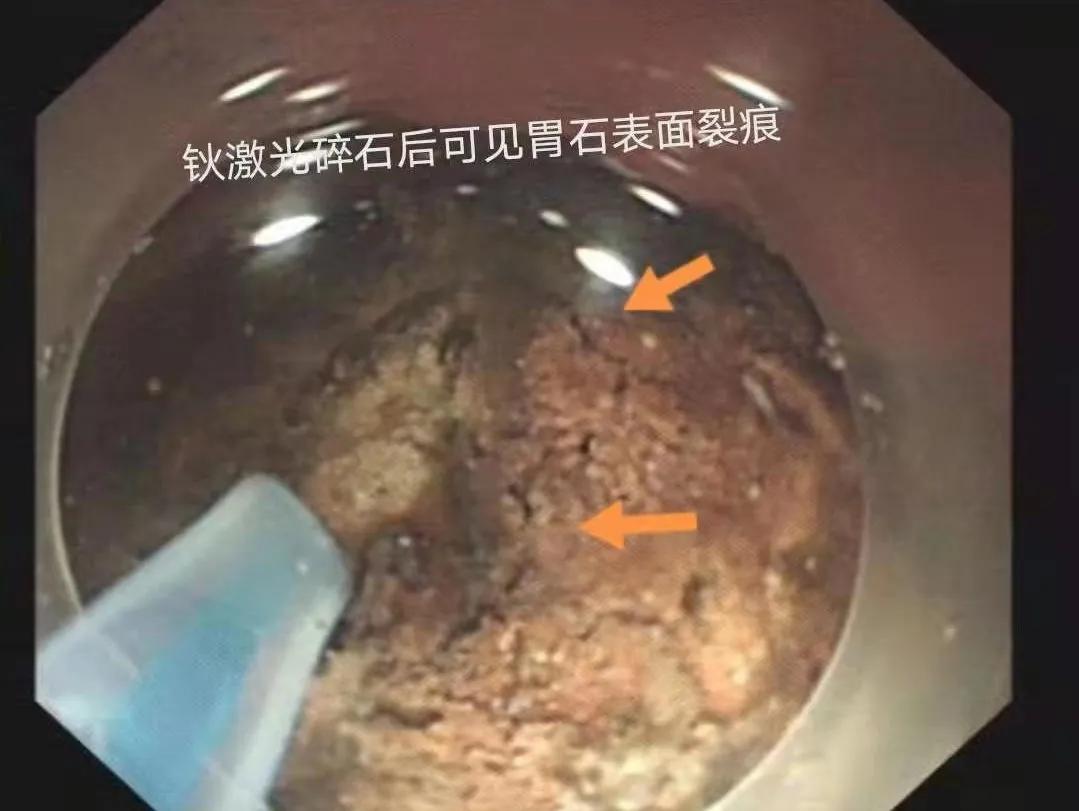 胃石症能吃什么药,胃石症有必要做手术治疗吗