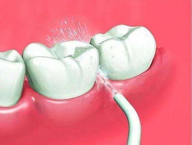 美白牙齿的漱口水有哪些,什么漱口水好用可以让牙齿变白