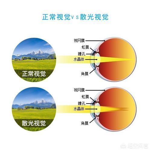 儿童散光和青光眼有什么区别,看东西有重影是散光吗青光眼