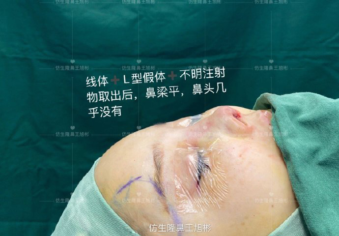 骨粉注射隆鼻皮肤变薄怎么办,线雕隆鼻会引起鼻挛缩吗