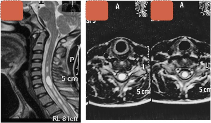 儿童脊髓空洞加脊柱侧弯,合并脊髓空洞的先天性脊柱侧弯
