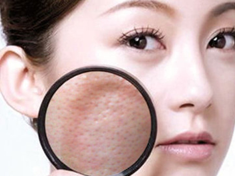 打败毛孔!下一个反孔精英就是你!