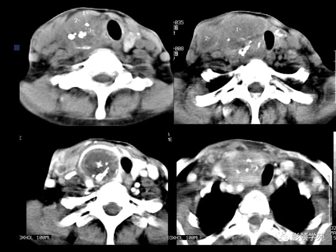 腮腺疾病影像学诊断,腮腺肿块影像诊断