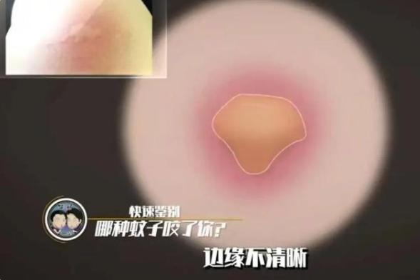 三种常见蚊子咬的包如何快速止痒消除，三种被叮的包要分清楚