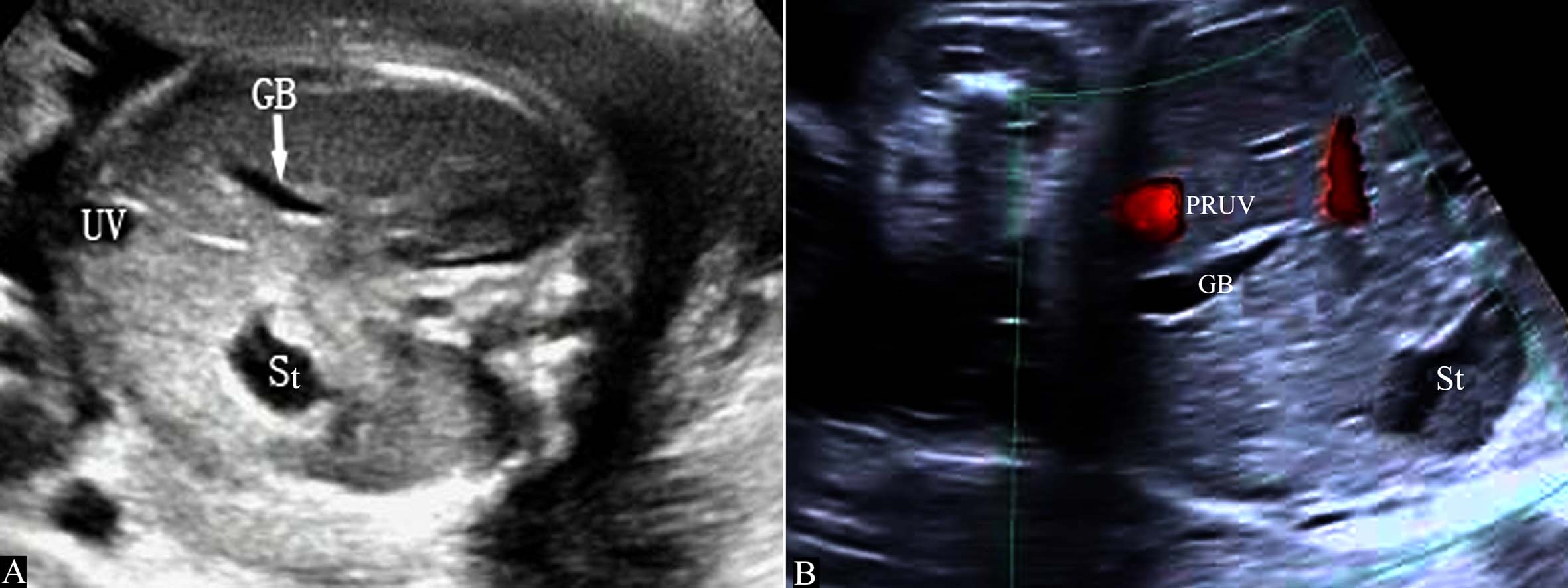 做高清彩超能看出脐带扭转吗,脐带超声异常