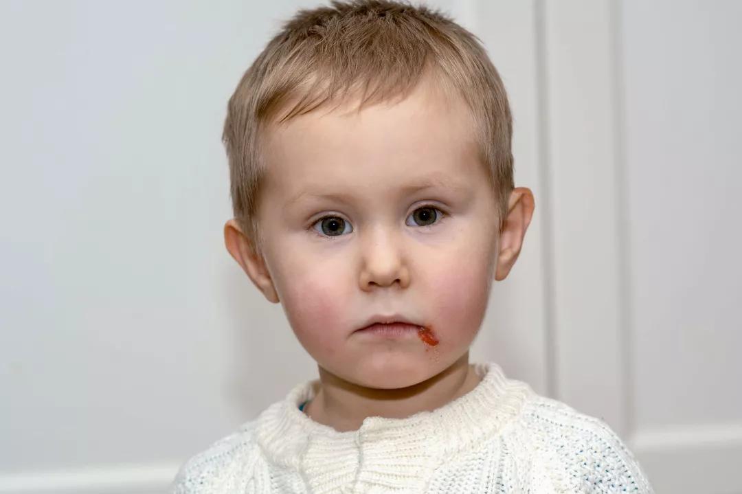 宝宝皮肤溃烂反复无法愈合,婴儿皮肤溃烂怎么治疗最有效