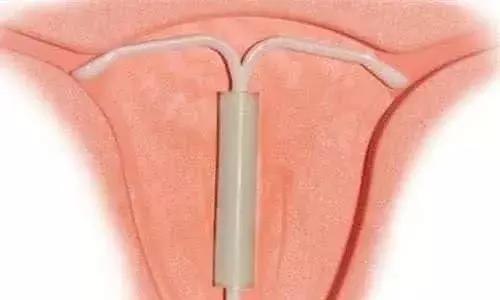 比生孩子还疼的是啥病,哪种节育环不容易怀孕