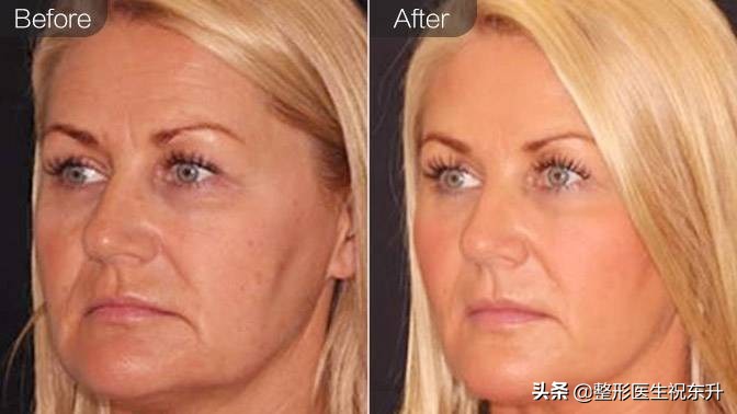 超声刀和热玛吉有必要都做吗,超声炮热玛吉热拉提哪个效果好