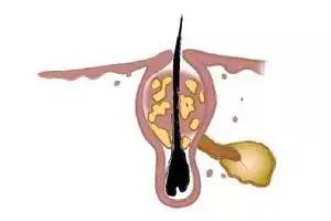卸妆水可以去除鼻子上的黑头吗,鼻子上的黑头去除后怎么收缩毛孔