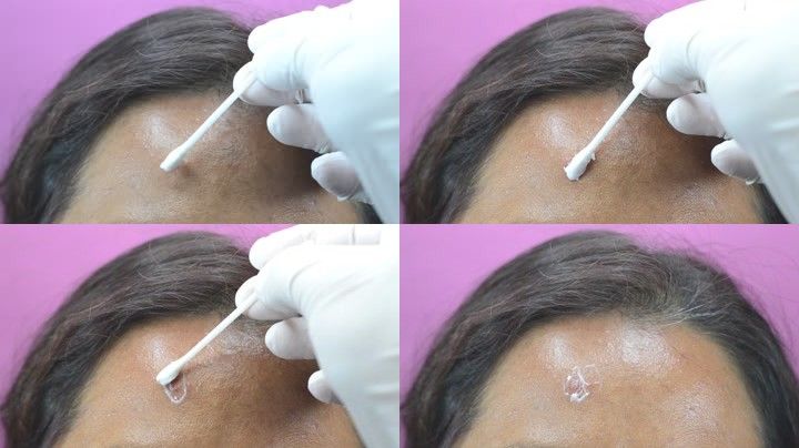 痘坑痘印消炎修复的最佳方法,是不是痘痘消炎了就有痘坑