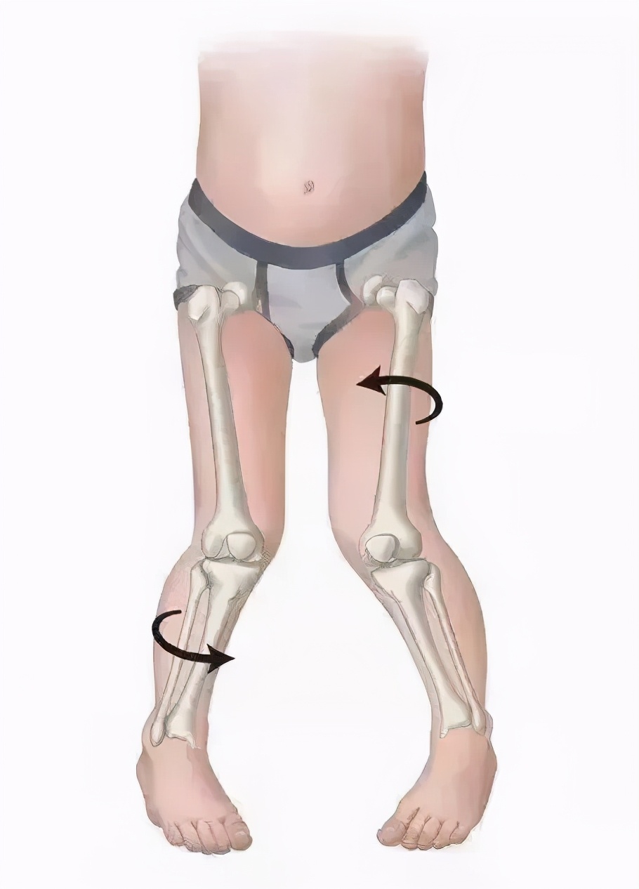 小腿外翻如何把腿练直,小腿外翻腿不直怎么矫正训练