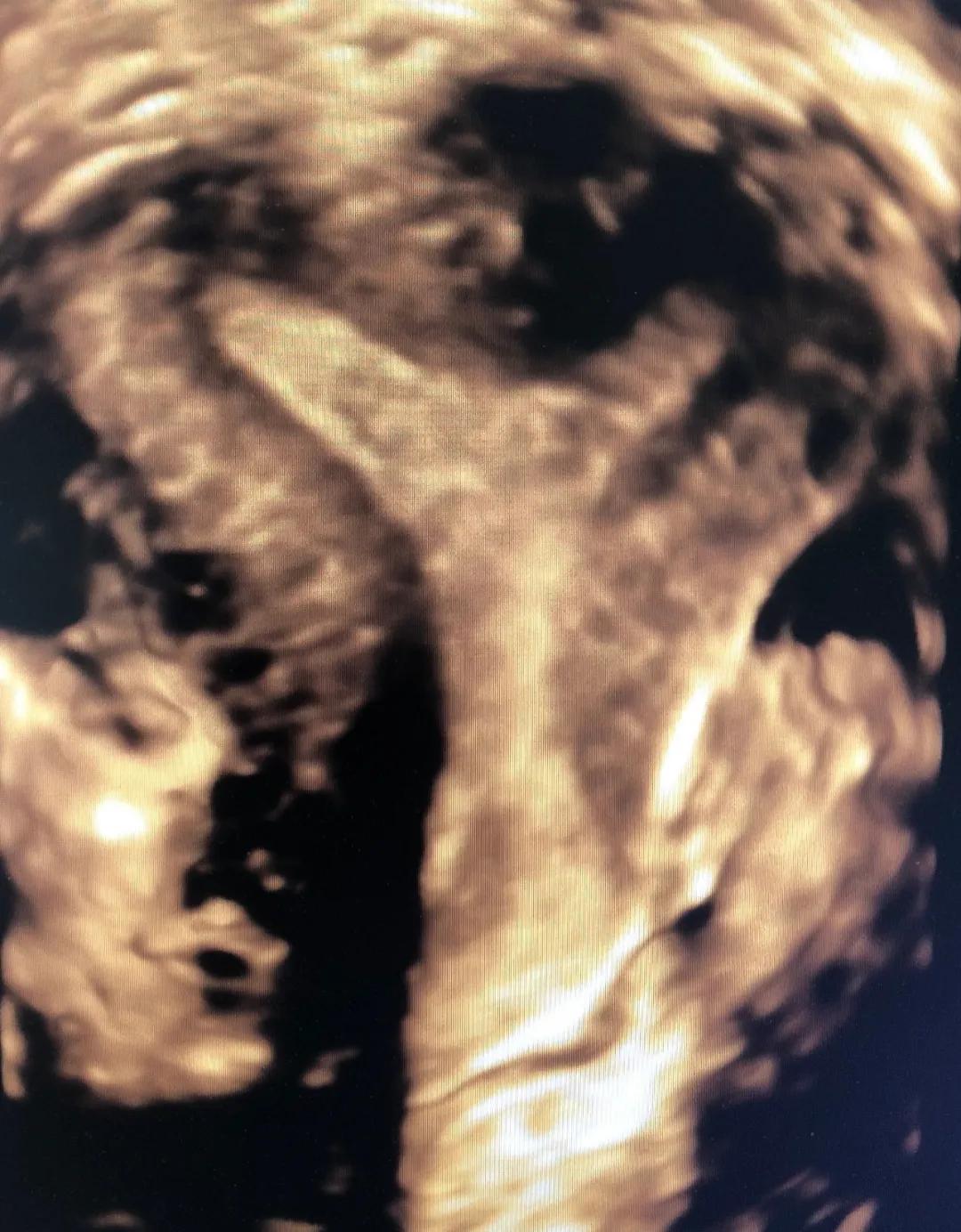 渭南市妇幼保健院四维单子,超声诊断弓形子宫