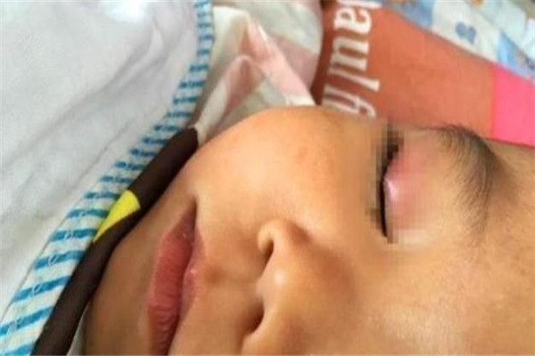 宝宝误拿502胶水滴眼睛怎么办,宝宝误将502滴到眼睛怎么办