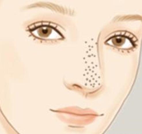 闭口黑头粉刺怎么才能根除,有效解决黑头闭口粉刺的问题