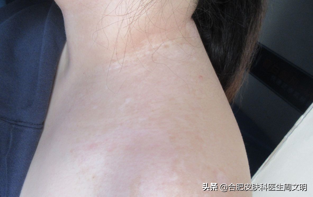 大面积白癜风打什么针可以全白,大面积白癜风吃啥药抑制黑色素