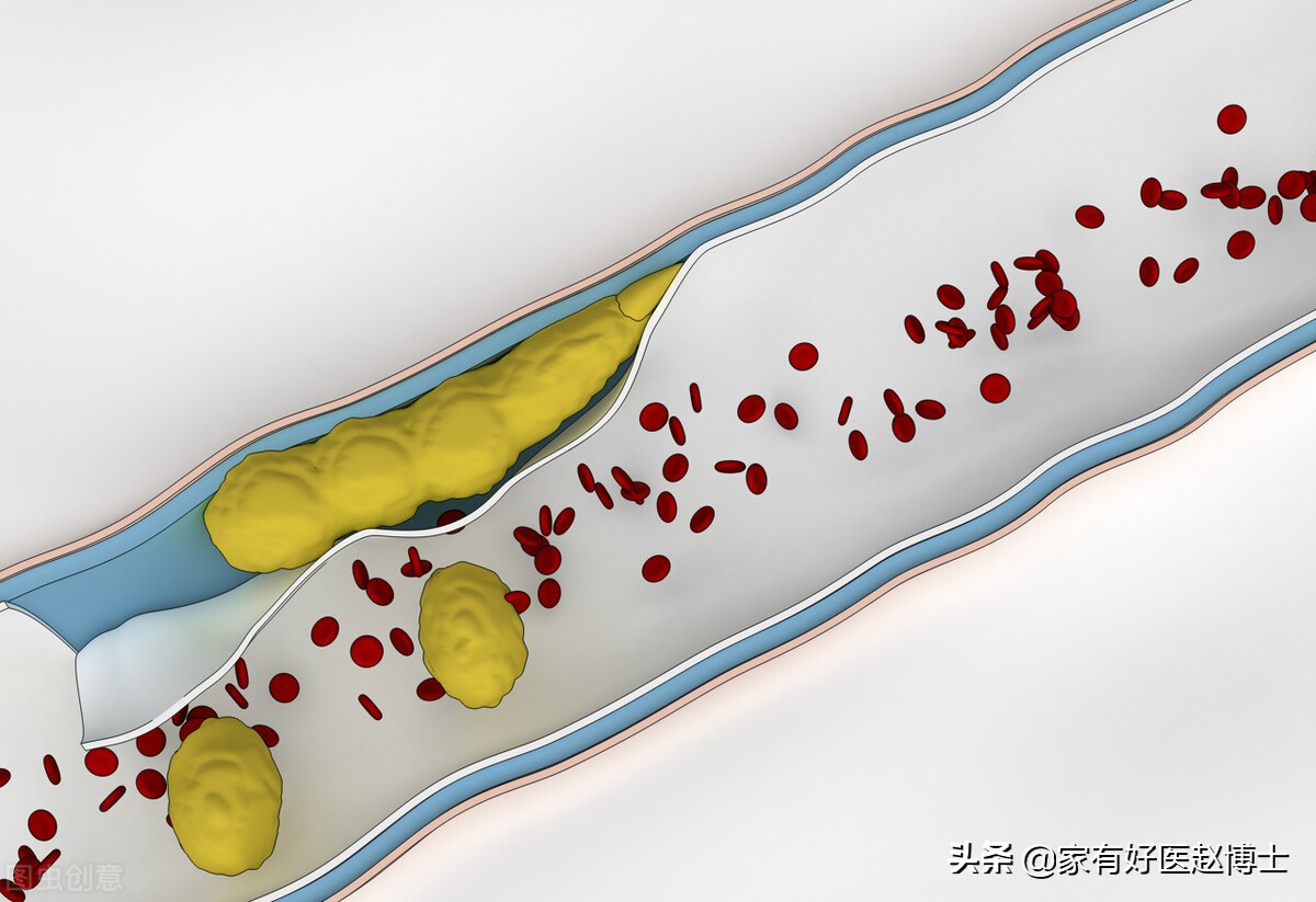 到底能不能软化血管和逆转斑块,使血管斑块变小要用多大剂量他汀