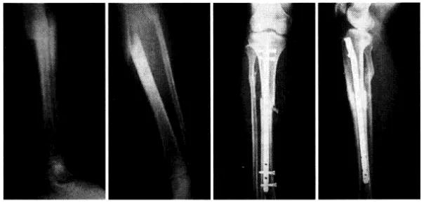 一文讲透，创伤骨科中常用的髓内钉
